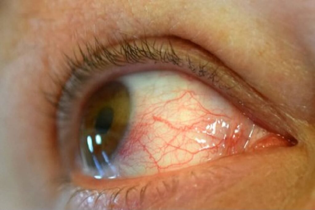 chlamydial conjunctivitis