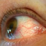 chlamydial conjunctivitis