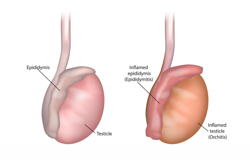 chlamydial epididymitis