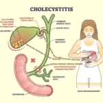 cholecystitis