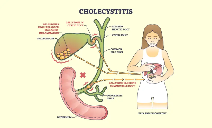 cholecystitis