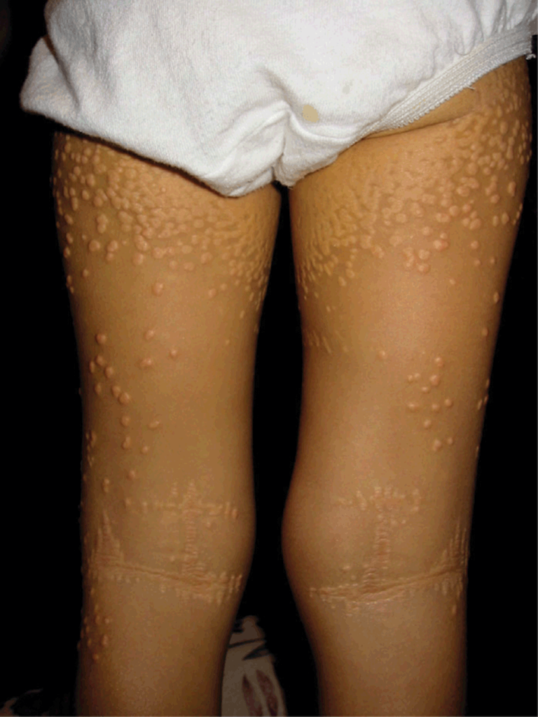 cholestatic pruritus in patients with alagille syndrome