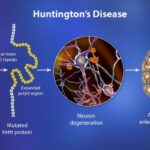 chorea associated with huntington's disease