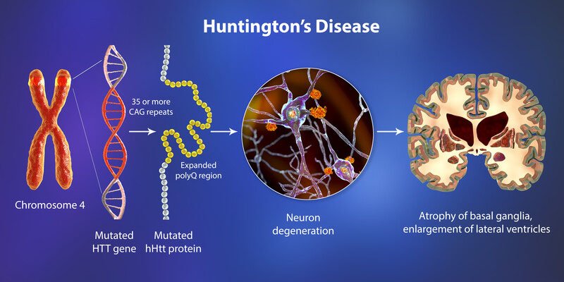 chorea associated with huntington's disease