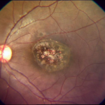 chorioretinitis