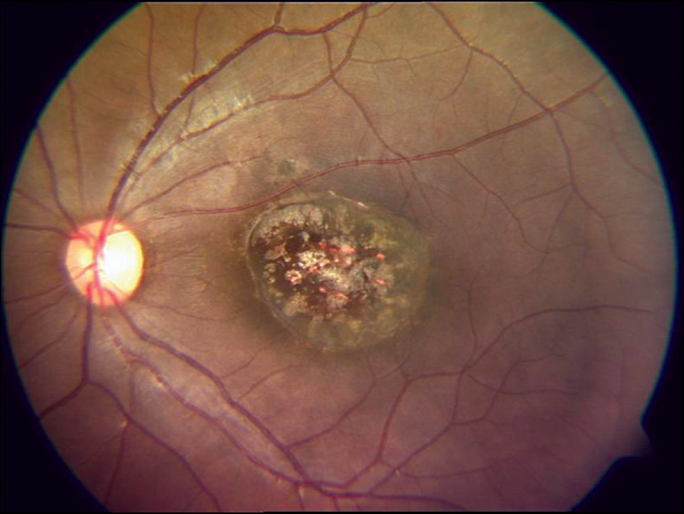 chorioretinitis