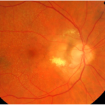 choroidal neovascularization