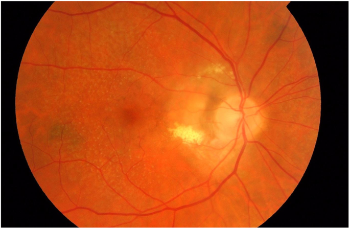 choroidal neovascularization