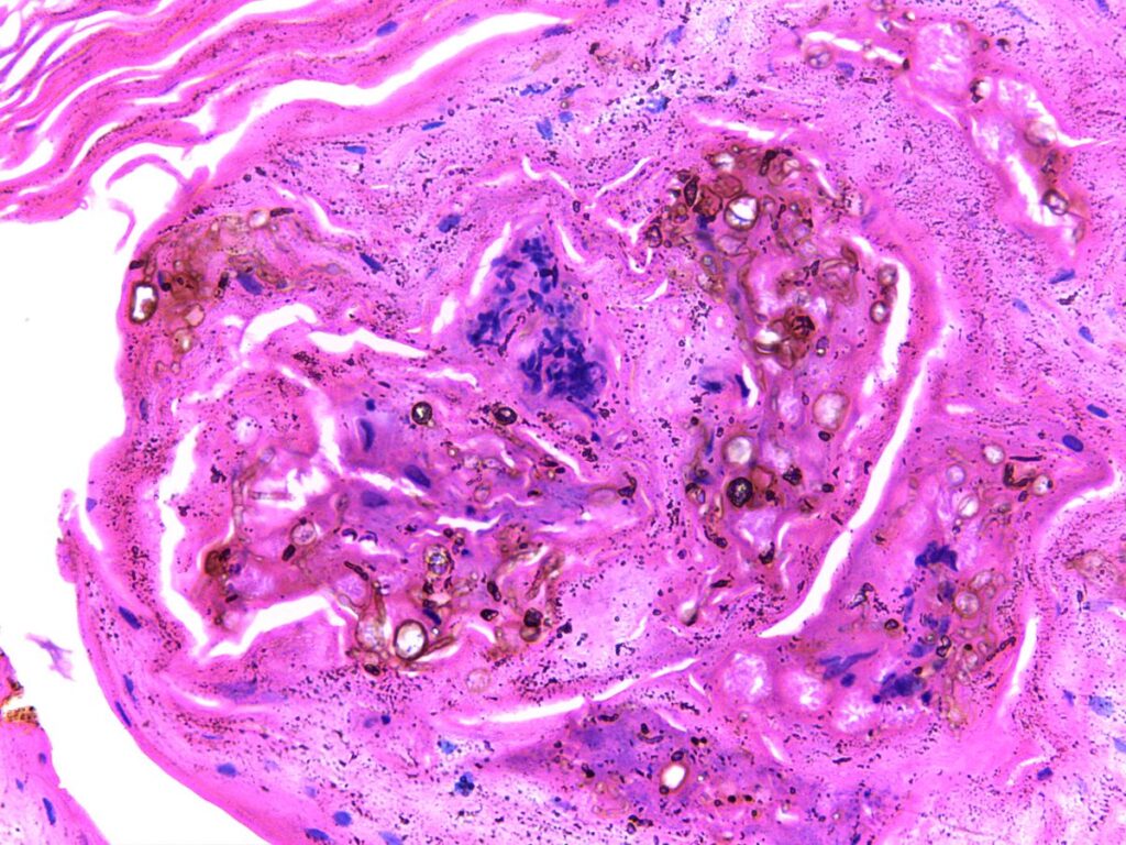 chromoblastomycosis