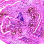 chromoblastomycosis