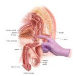 chronic bacterial prostatitis