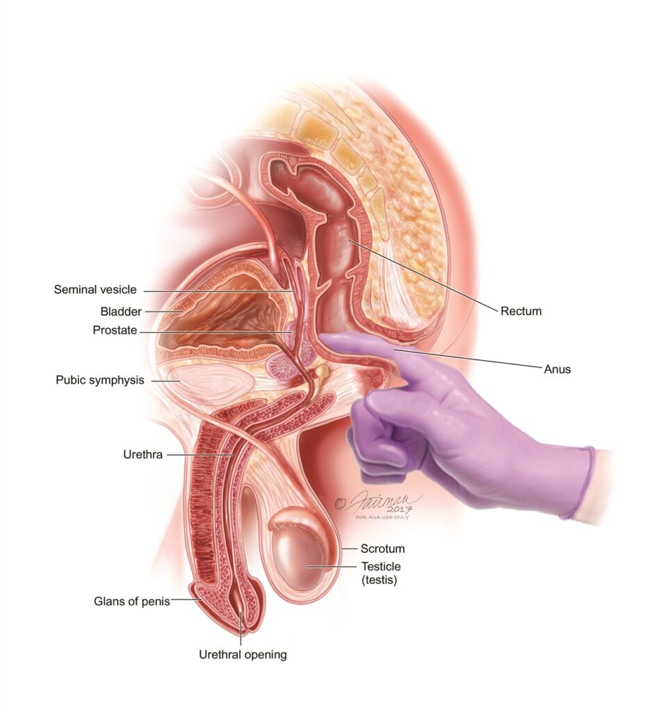 chronic bacterial prostatitis