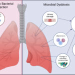 chronic bronchitis with bacterial exacerbation