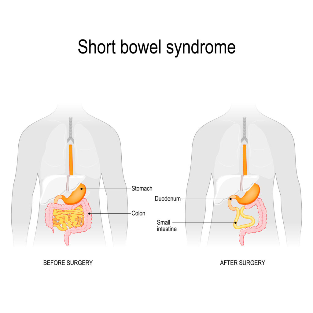 chronic diarrhea associated with short bowel syndrome