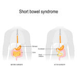 chronic diarrhea associated with short bowel syndrome