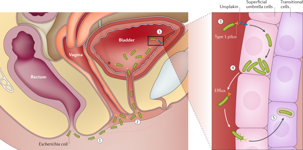 chronic enterococcus faecalis prostatitis