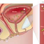 chronic enterococcus faecalis prostatitis