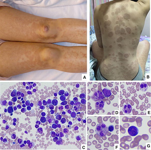 chronic eosinophilic leukemia