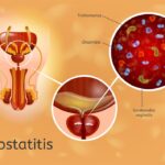 chronic escherichia coli prostatitis