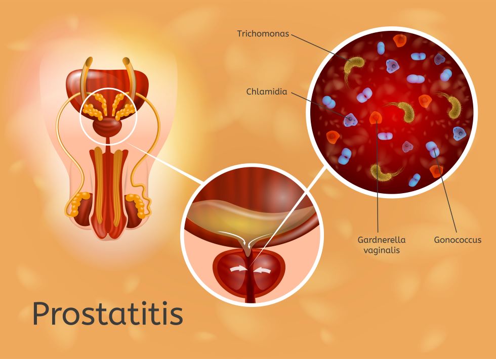 chronic escherichia coli prostatitis