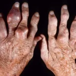 chronic gouty arthritis