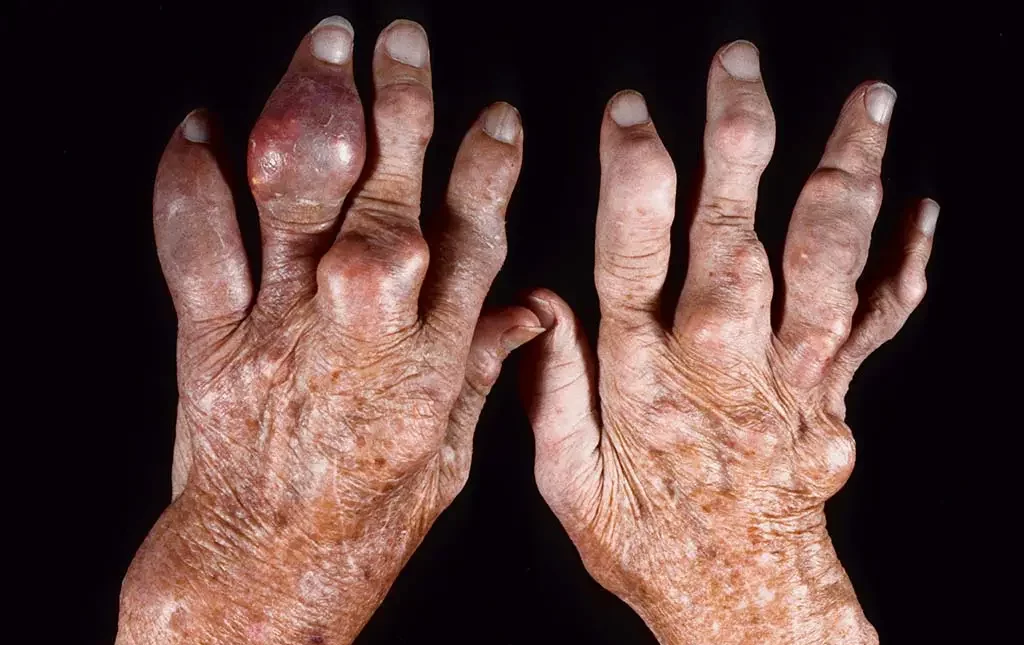 chronic gouty arthritis