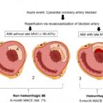 chronic heart failure following myocardial infarction