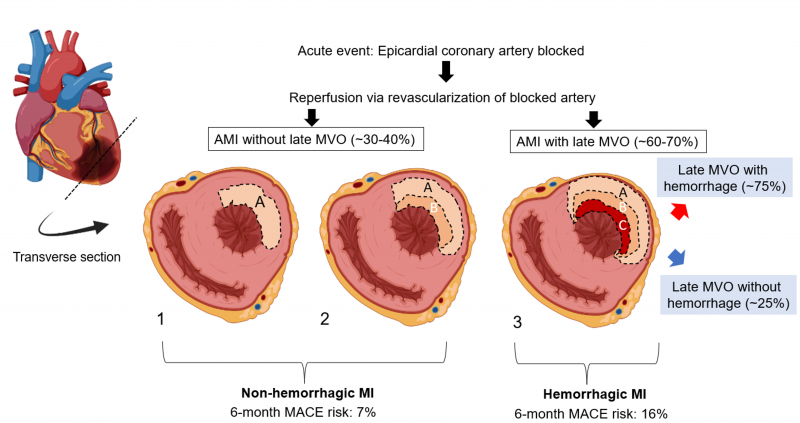 chronic heart failure following myocardial infarction