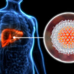 chronic hepatitis c