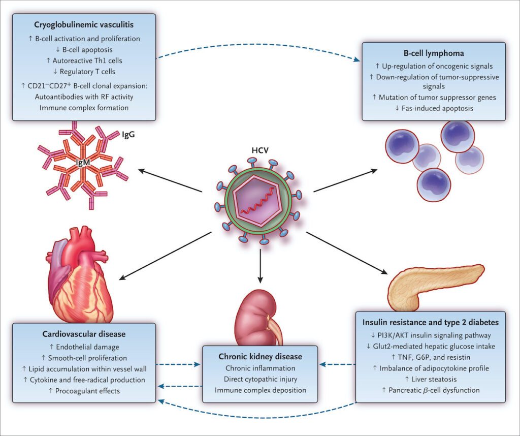 chronic hepatitis c - genotype 5