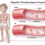 chronic idiopathic thrombocytopenic purpura