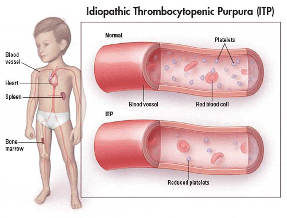 chronic idiopathic thrombocytopenic purpura