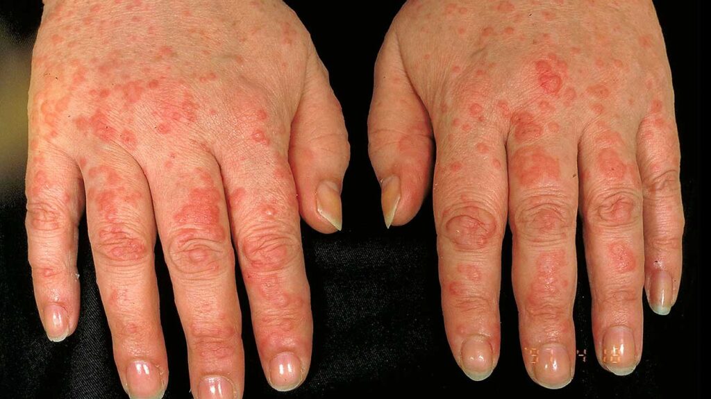 chronic idiopathic urticaria