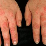 chronic idiopathic urticaria