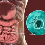 chronic intestinal amebiasis