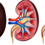 chronic kidney disease associated with type 2 diabetes mellitus