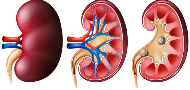 chronic kidney disease associated with type 2 diabetes mellitus