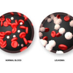 chronic myelocytic leukemia