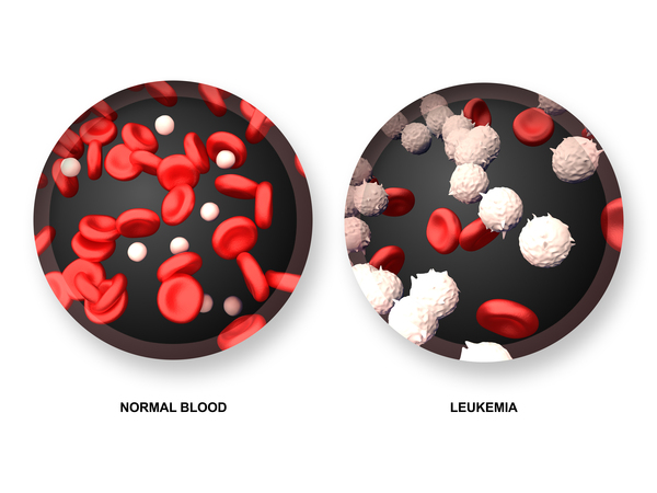 chronic myelocytic leukemia