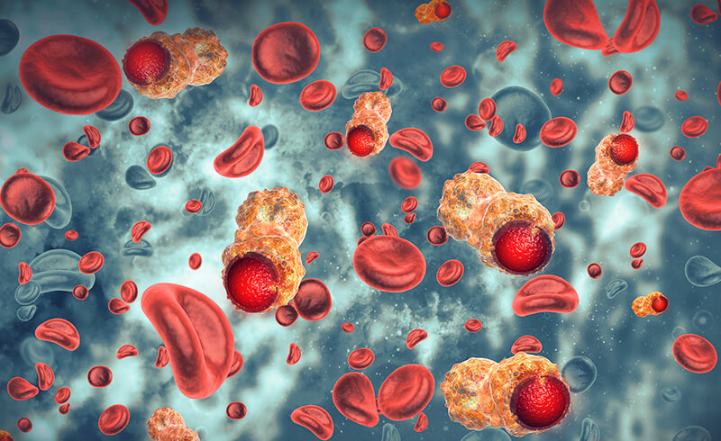 chronic myelomonocytic leukemia