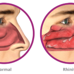 chronic non-allergic rhinitis