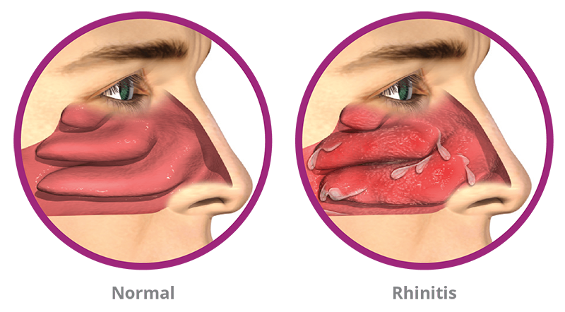 chronic non-allergic rhinitis