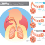 chronic obstructive asthma