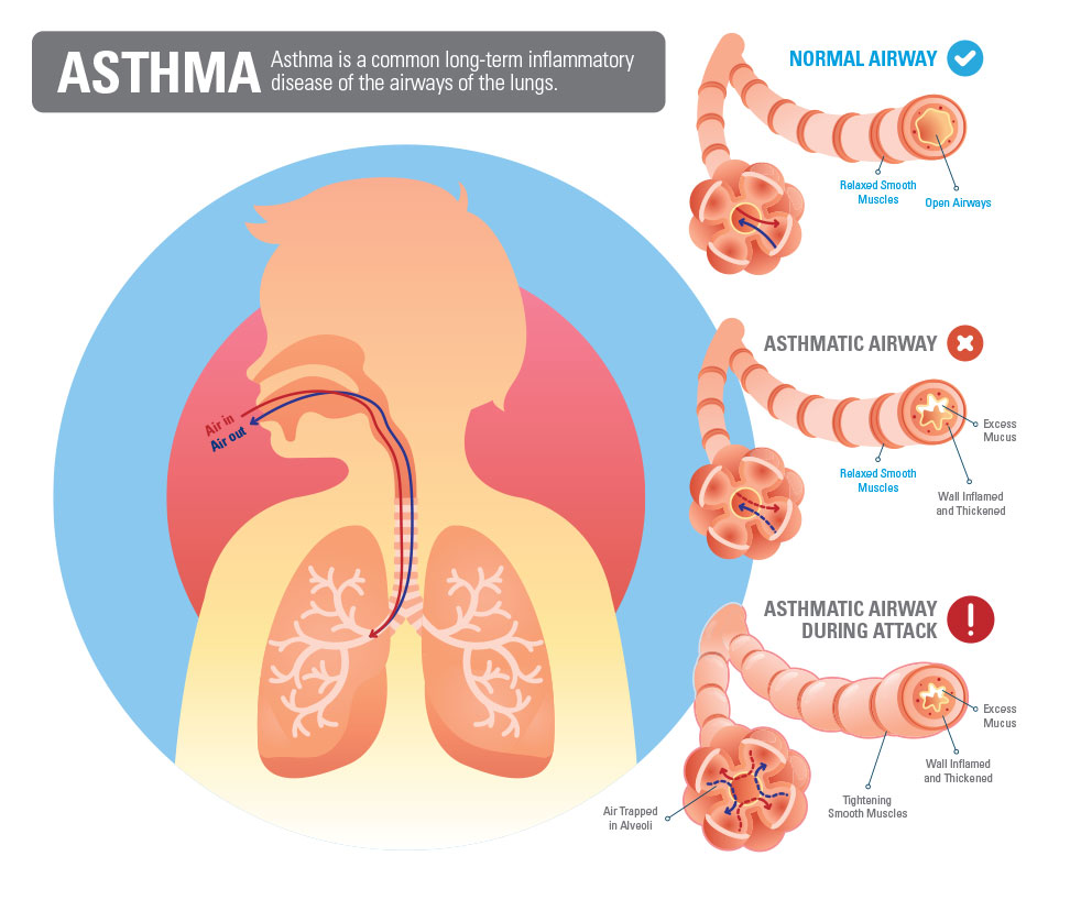 chronic obstructive asthma