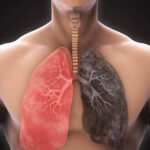 chronic obstructive pulmonary disease