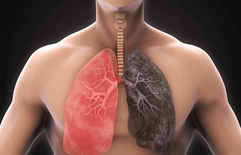 chronic obstructive pulmonary disease