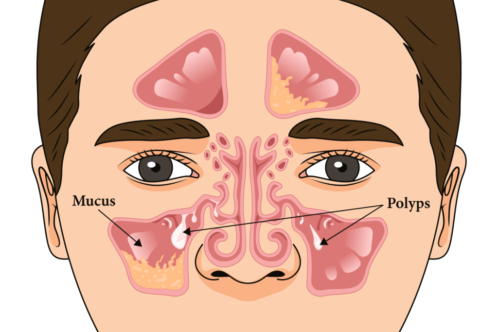 chronic rhinosinusitis without nasal polyps