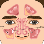 chronic rhinosinusitis without nasal polyps