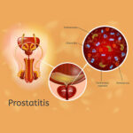 chronic staphylococcus epidermidis prostatitis