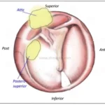 chronic tubotympanic suppurative otitis media